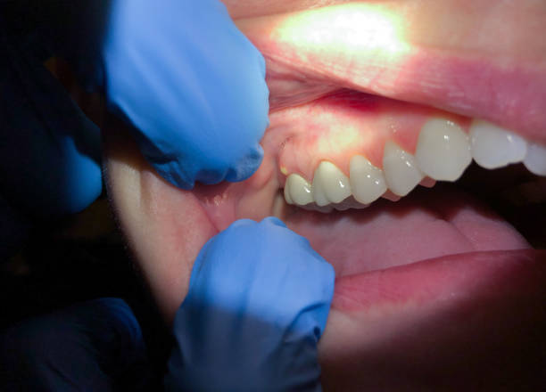 Best Emergency Gum Pain Relief  in Denton, NC